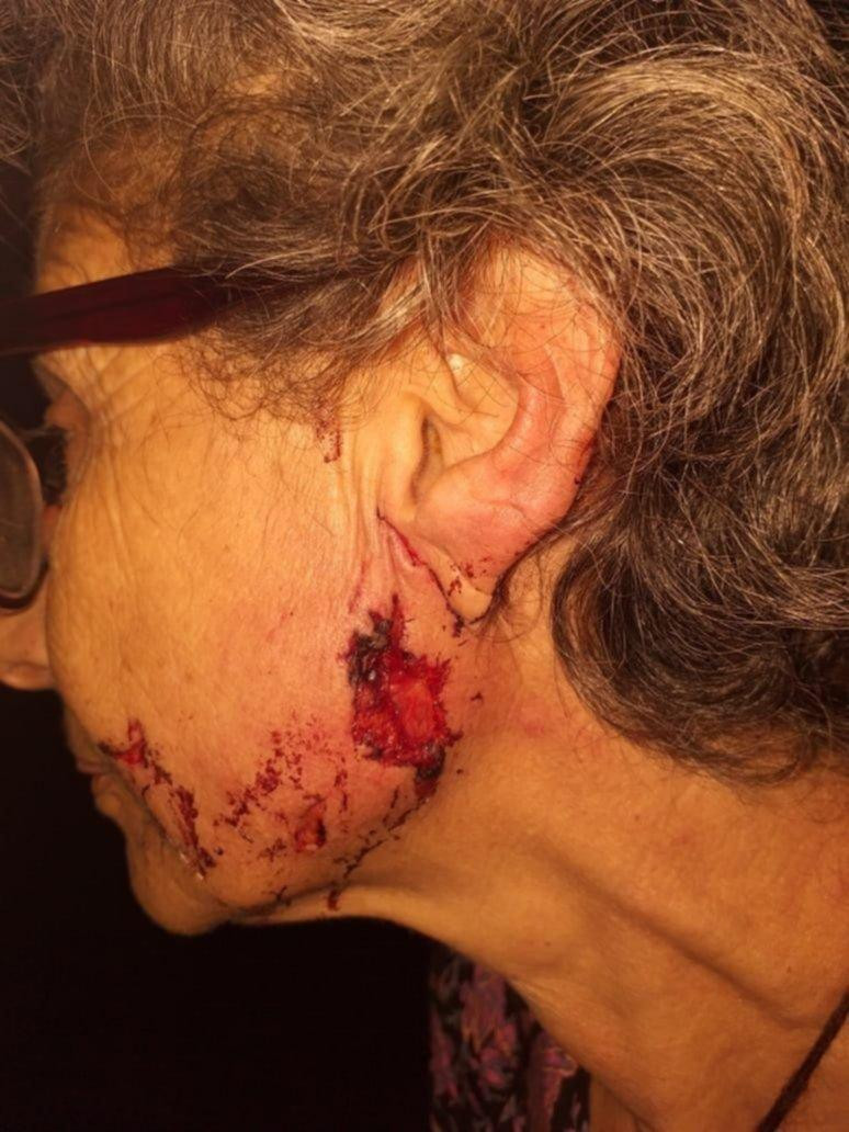 Perros pitbull atacan a una mujer, le mordieron la cara y le arrancaron parte de la oreja