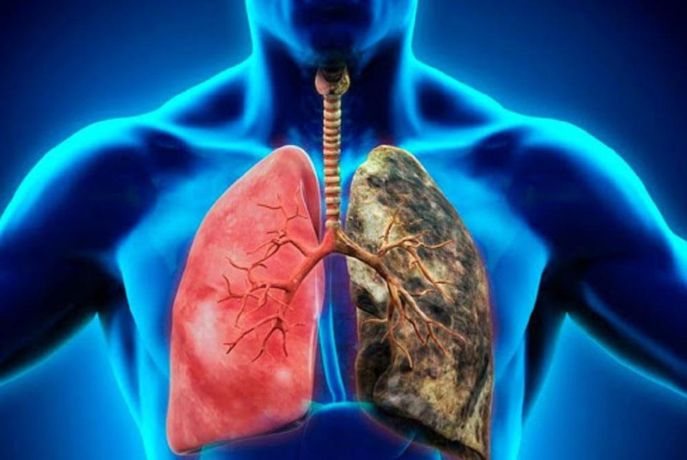 Cáncer de pulmón, salud