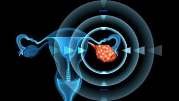 El cáncer de ovario ocupa el quinto lugar en frecuencia de tumores en Argentina
