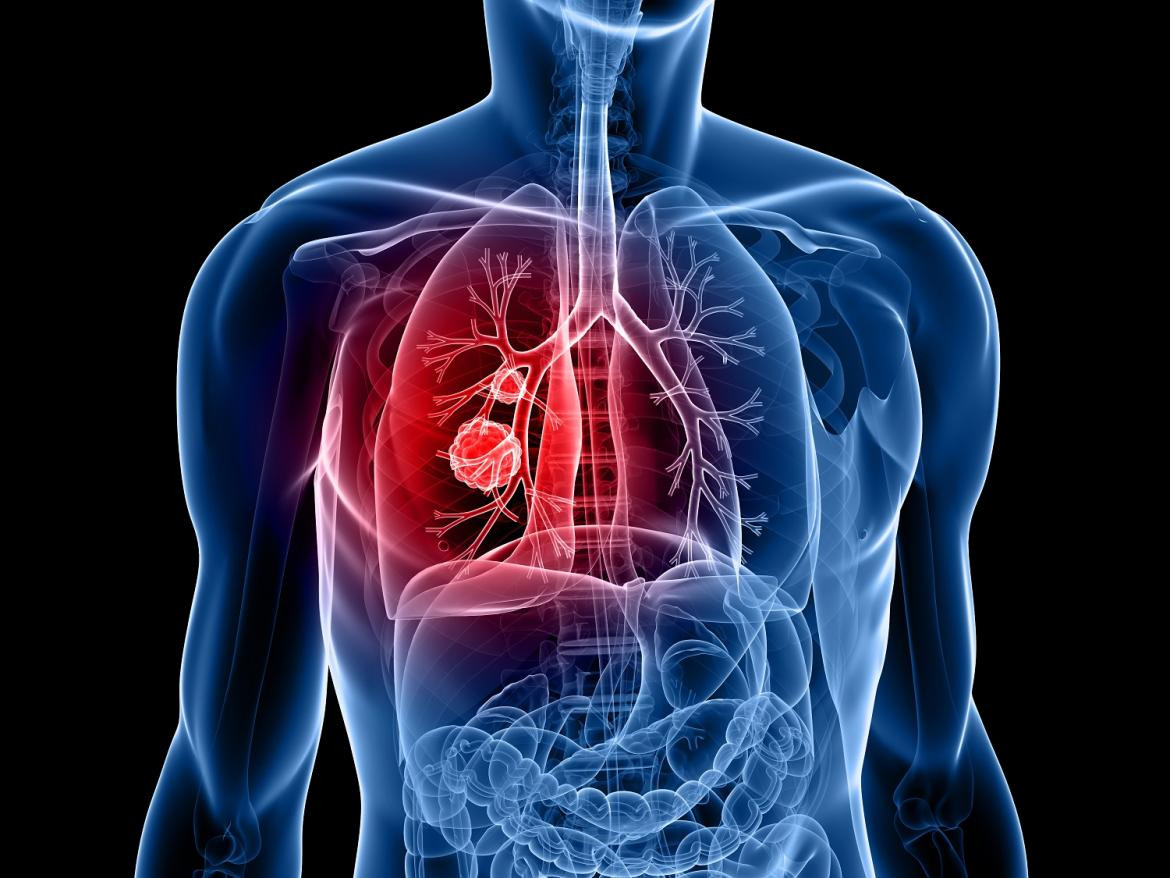 Salud - Cáncer pulmón