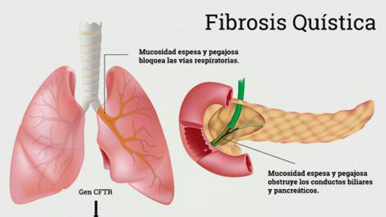 Fibrosis quística, OMS