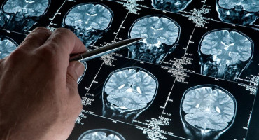 El importante descubrimiento en la lucha contra el Alzheimer
