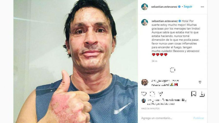 Sebastián Estevanez, quemadura en su rostro, accidente con alcohol, Instagram